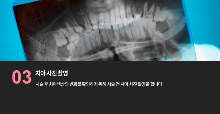 시술 후 치아색상의 변화를 확인하기 위해 시술 전 치아 사진 촬영을 합니다.
