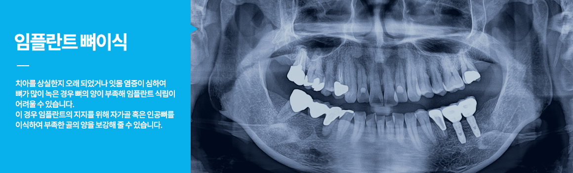 평균적인 성인의 치아개수는 약 28~32개로 치아가 필요한 제 기능을 다하기 위해서는 결손 된 치아 없이 모든 치아가 제 자리에 있어야 합니다. 하지만 예기치 못한 사고나 심한 치주질환 등으로 치아를 상실하게 되는 경우도 있는데, 이때 이를 방치하게 되면 빠진 치아의 자리에 치아와 맞물리는 치아가 아래로 내려오거나 도미노처럼 주변의 치아들이 빈 치아 공간으로 쓰러지는 현상이 나타나 전반적으로 치아의 간격이 넓어질 수 있어 치아의 탈락이 이루어진 자리에는 새로운 대체 치아를 식립하는 것이 바람직합니다. 
씹는 즐거움 선물!! 치주질환이나 사고 등으로 인해 상실된 자아의 자리에 인체에 무해하면서도 부작용이 없는 티타늄으로 제작된 본체를 심고, 그 위에 내 자연 치와 유사한 보철물을 씌워 본래의 내 치아와 같은 기능을 회복시켜 주는 치료입니다. 자연치아는 최대한 살리고, 꼭 필요한 만큼의 최소 임플란트 식립 원칙!